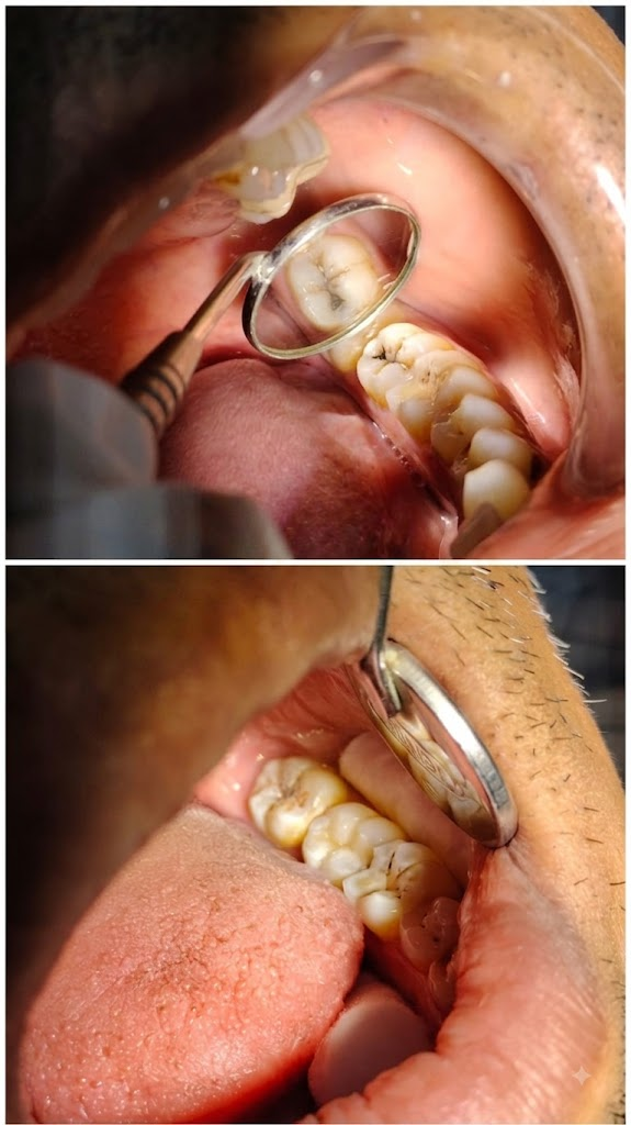 Hand carved direct composite bonding before and after