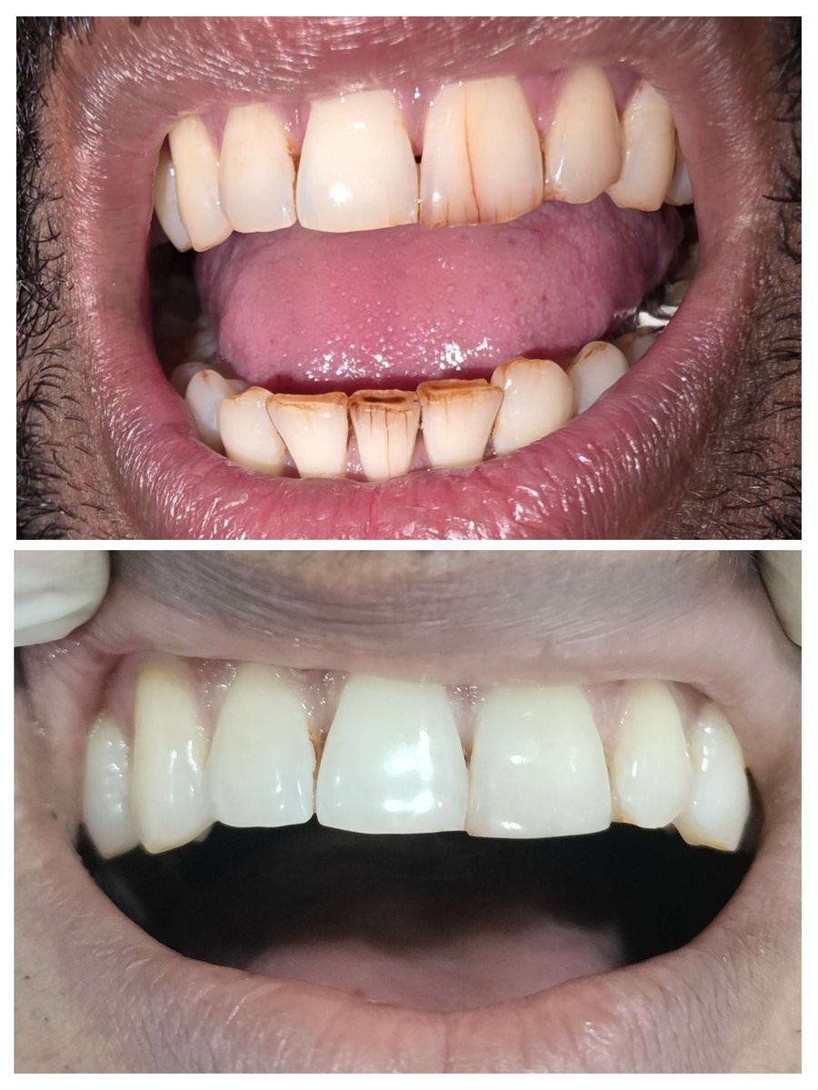Aesthetic composite restoration