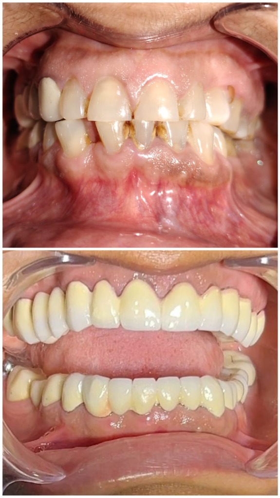 Crowns and bridges restoration before and after
