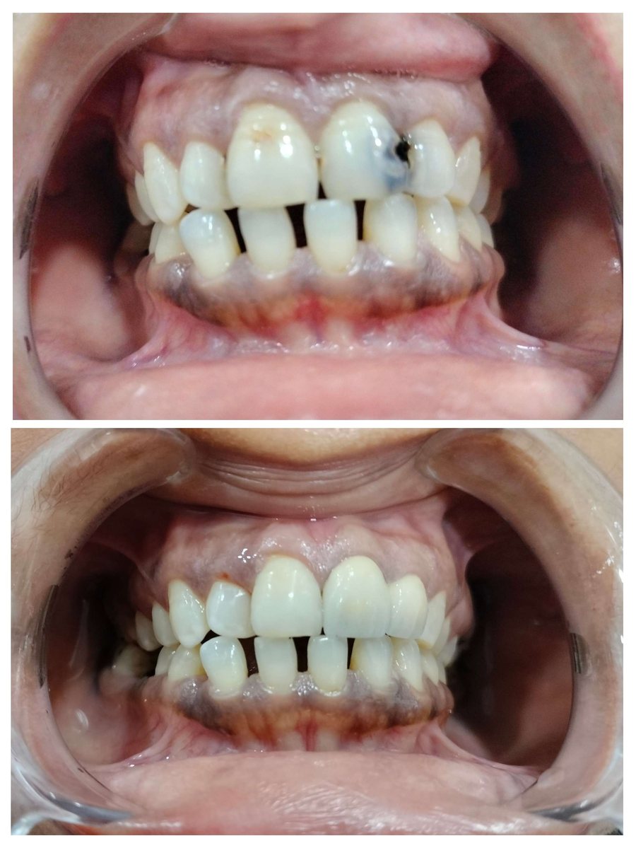 Dental crown