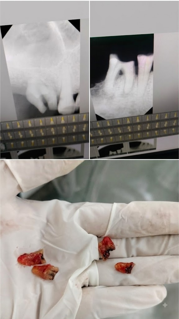 Gentle dental extraction and radiographic evaluation