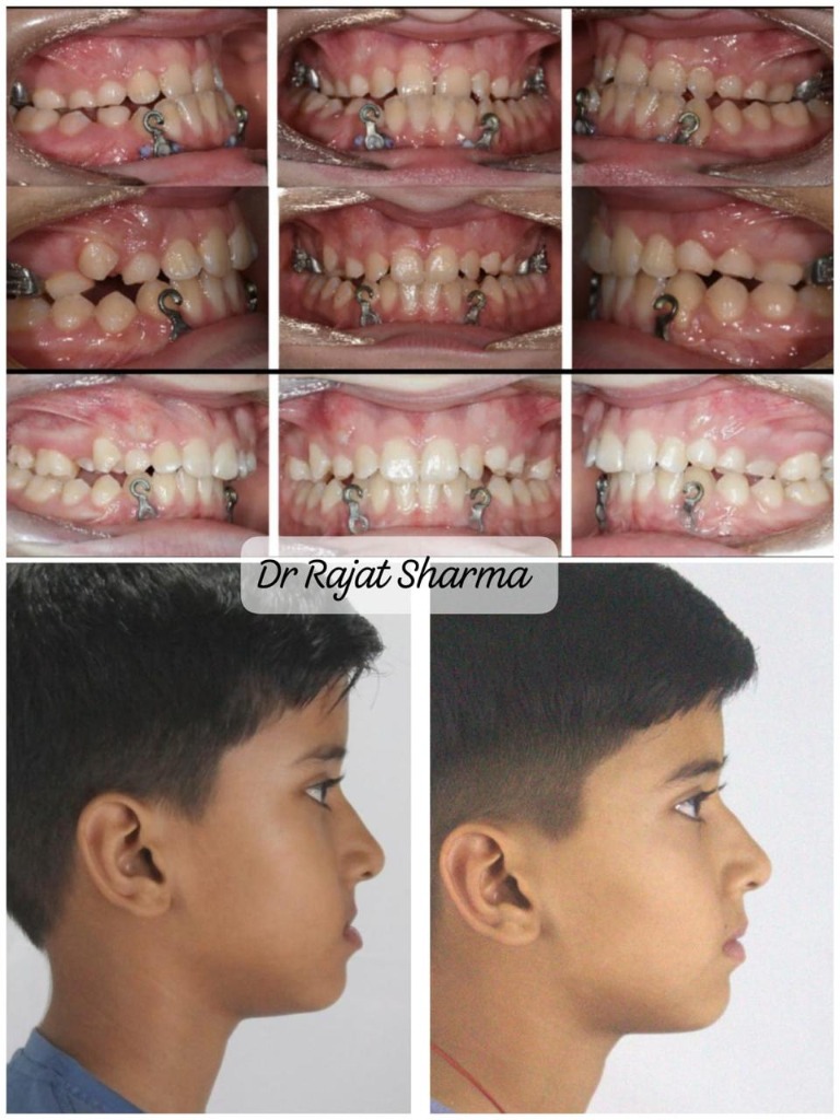 Orthodontic jaw profile alignment and bite correction before and after