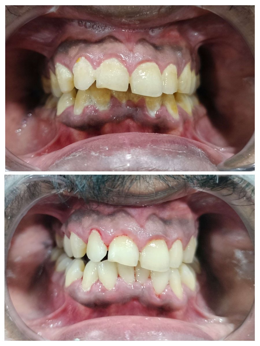 Scaling and polishing