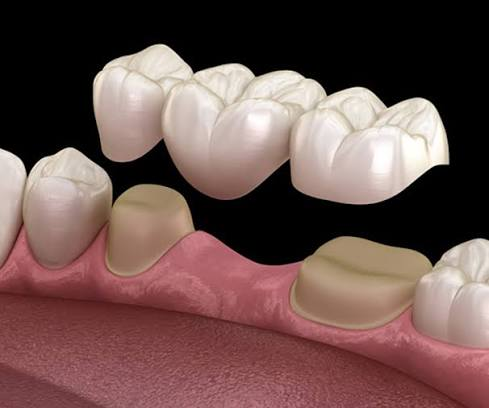 Dental crowns and bridges