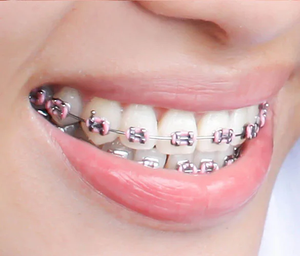 Dental Braces orthodontic treatment