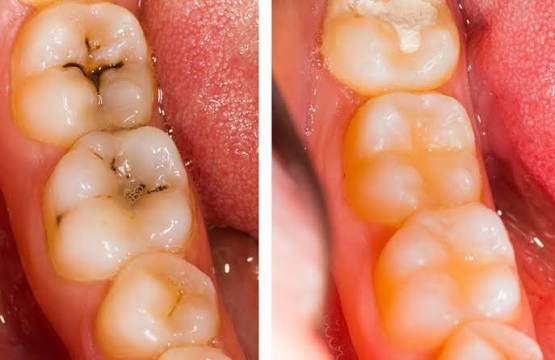 Tooth fillings and cavity restoration