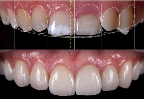 Smile Designing and aesthetic transformation