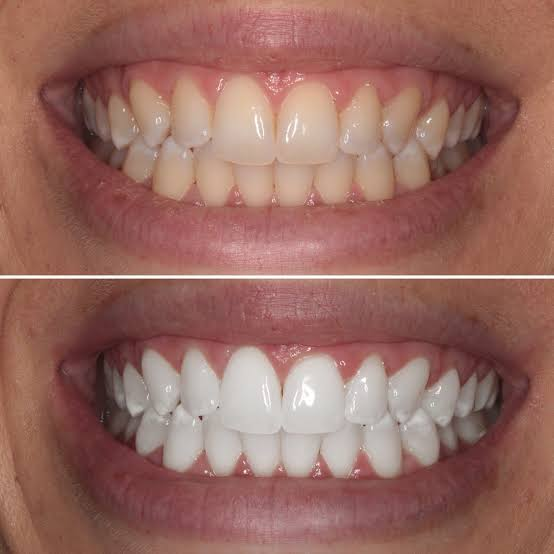 Teeth whitening shade-lifting treatment